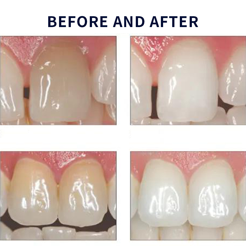 Opalwisdom-Kit de Blanchiment  - Teeth Whitening Doctor avis et prix