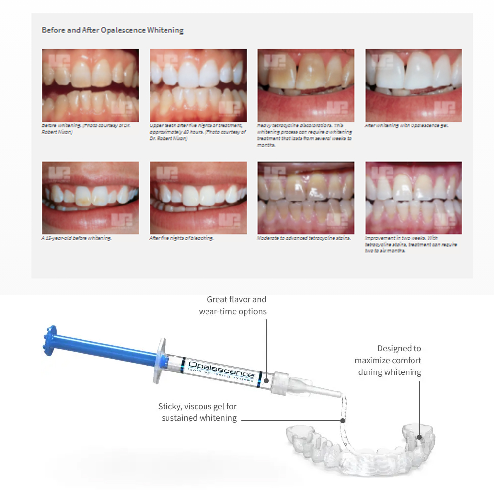Opalwisdom-Kit de Blanchiment  - Teeth Whitening Doctor avis et prix